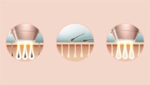 Expert IPL technology at-home. developed with dermatologists